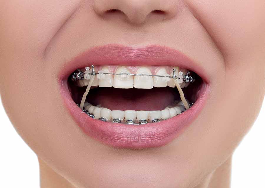 Mentor Braces